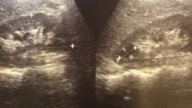 Cisto renal grande