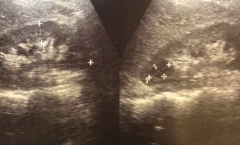 Cisto renal grande