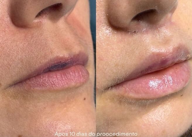 Cirurgia de Lip Lift