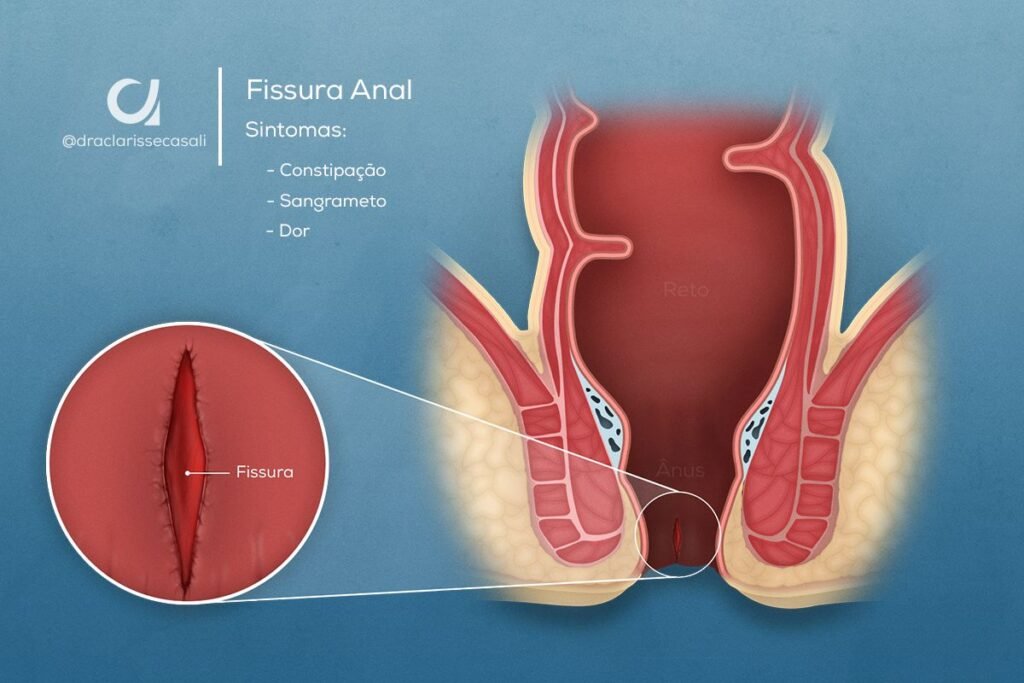 Fissura Anal