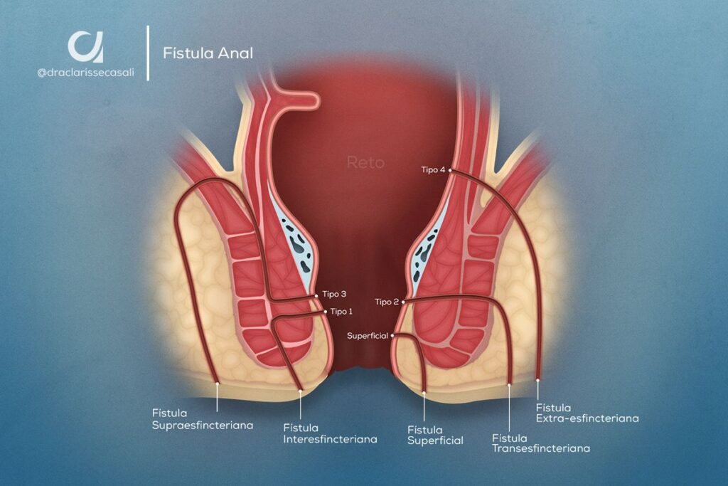 Fistula Anal