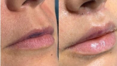 Lip Lifting: guia completo, segurança e resultados naturais