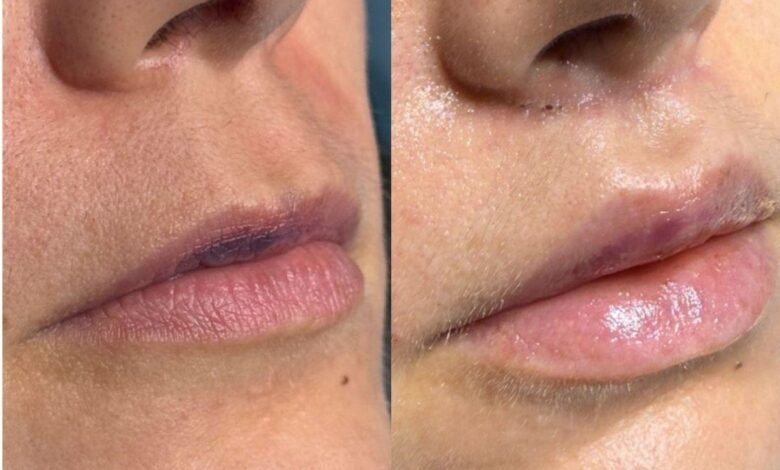 Lip Lifting: guia completo, segurança e resultados naturais