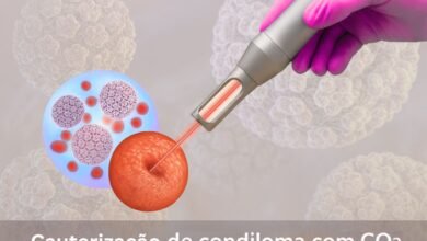 Cauterização de Condilomas com CO2