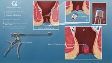 Ligadura Elástica para Hemorroidas: O Tratamento Ambulatorial de Primeira Escolha (Graus I a III)