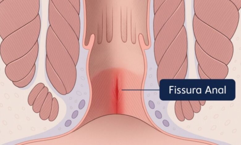 Fissura Anal e Dor Crônica: Guia de Manejo Baseado em Evidências
