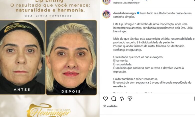 Lip Lift reparador: quando a reoperação é indicada e como buscar um resultado natural com segurança