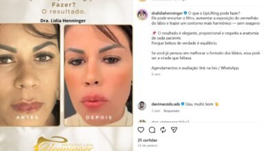 LipLifting: O que ele pode fazer por você?