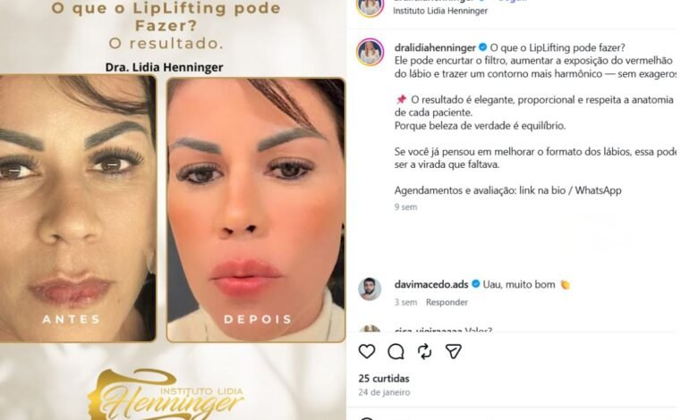 LipLifting: O que ele pode fazer por você?