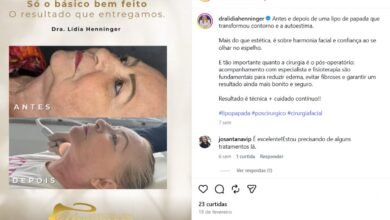 Lipo de papada antes e depois: como o contorno facial e a autoestima podem mudar