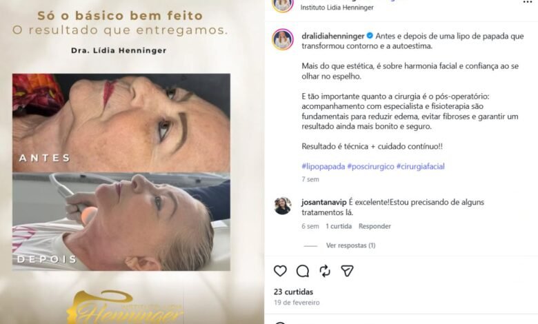 Lipo de papada antes e depois: como o contorno facial e a autoestima podem mudar
