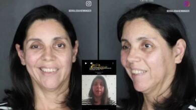 Depoimento de paciente com paralisia facial tratada com ozonioterapia