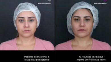 Depoimento de paciente que fez bichectomia: como foi a cirurgia e o resultado imediato