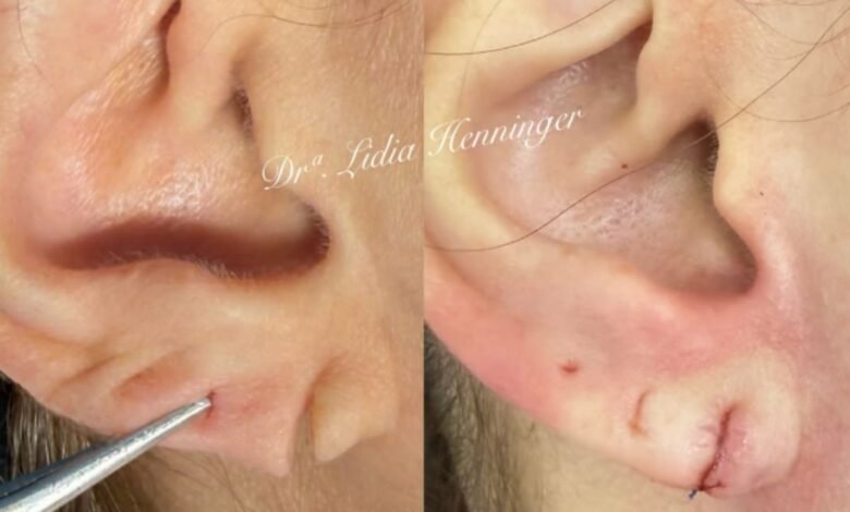 Lobuloplastia: como a reconstrução do lóbulo da orelha devolve estética, função e autoestima