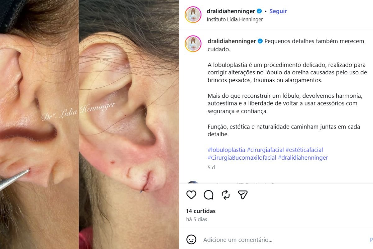 Quem deve avaliar a lobuloplastia?
